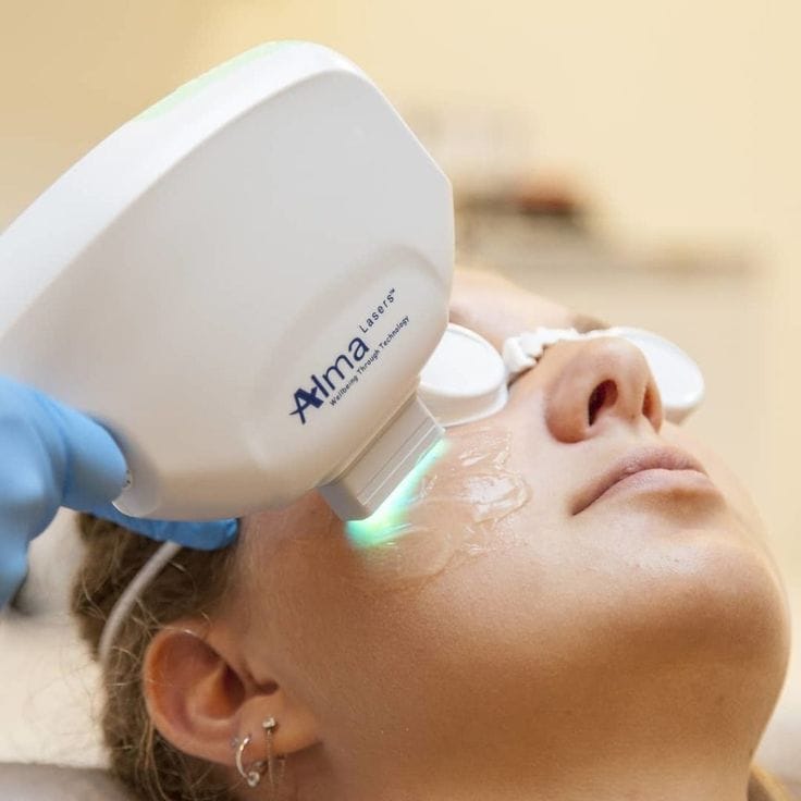 IPL treatment for skin