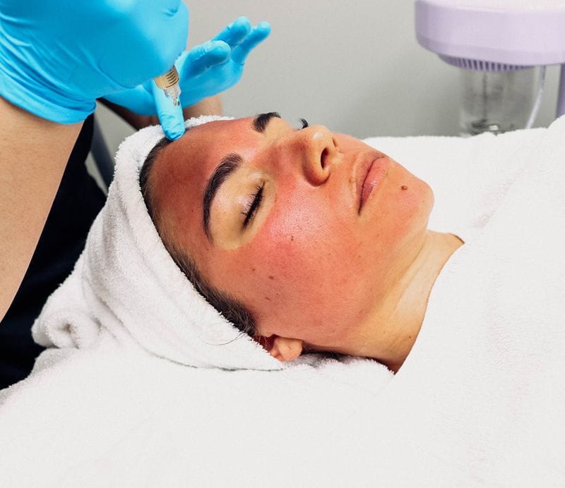 PRP facial treatment