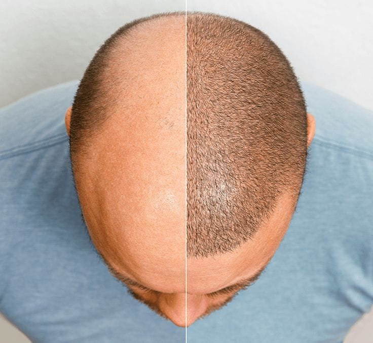 FUT hair transplant