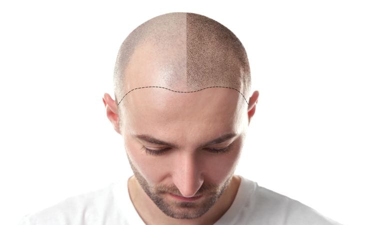 FUT hair transplant