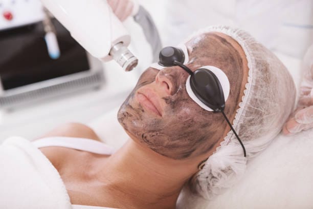 Carbon Laser Facial