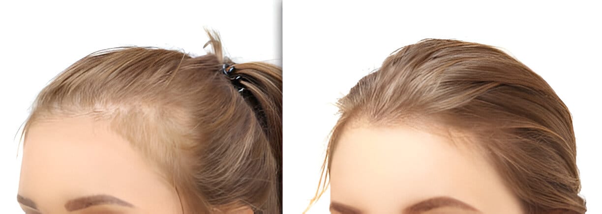 FUT hair transplant
