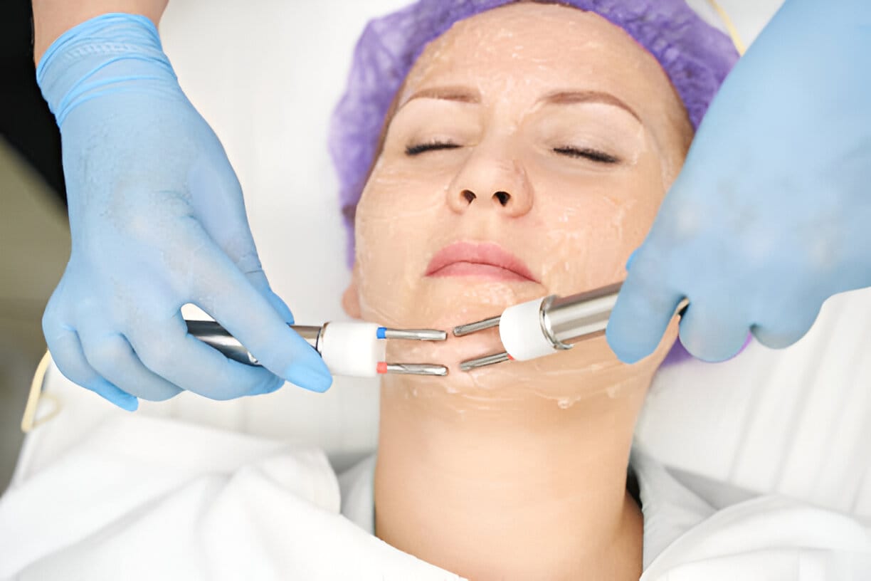 radiofrequency skin treatment