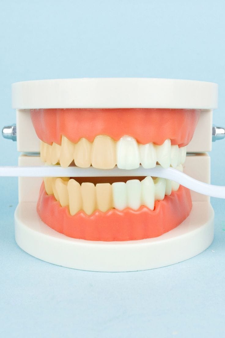 laser teeth whitening