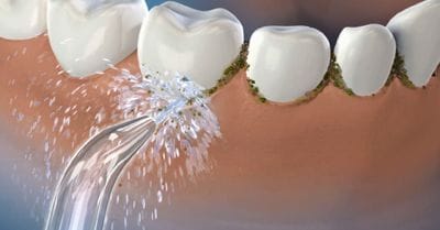 water flosser vs traditional floss