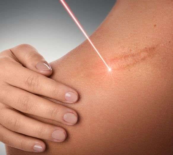 scars laser treatment