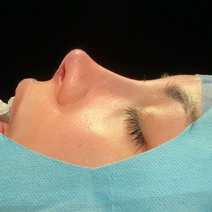 nose reshaping
