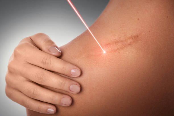 scars laser treatment