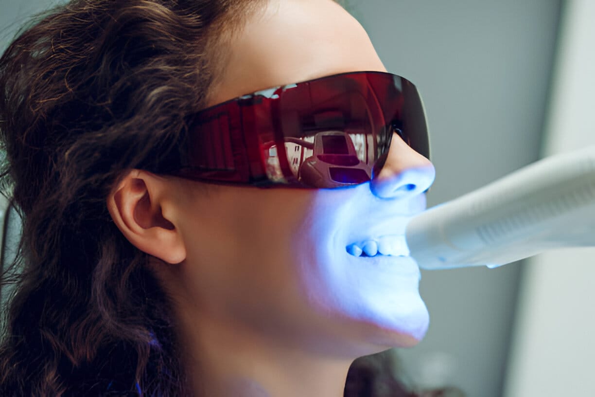 laser teeth whitening